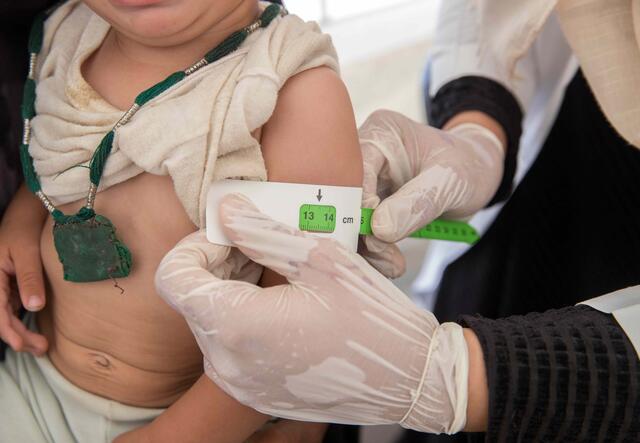 Ärztin untersucht Kleinkind mittels Bändchen auf Unterernährung